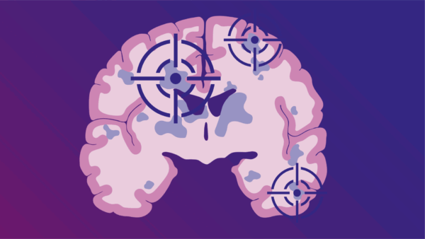 Nieuwe biomarker en therapeutisch doelwit voor MS geïdentificeerd