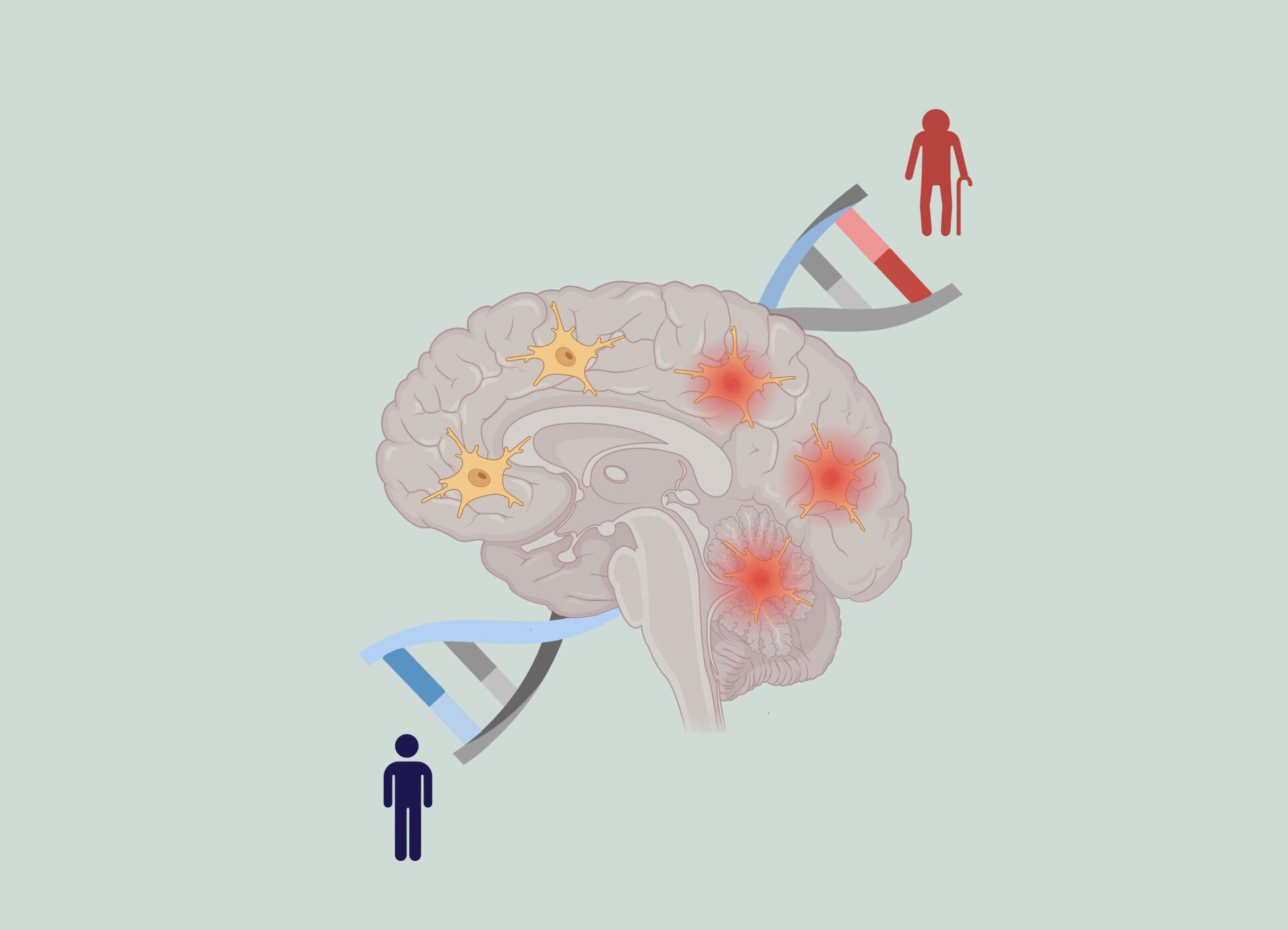 Nieuw ontdekte DNA-variatie houdt verband met snellere achteruitgang bij multiple sclerose