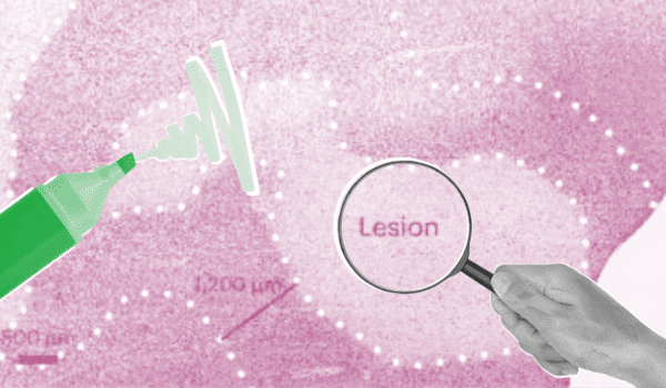 Nieuwe biomarker en therapeutisch doelwit voor MS geïdentificeerd